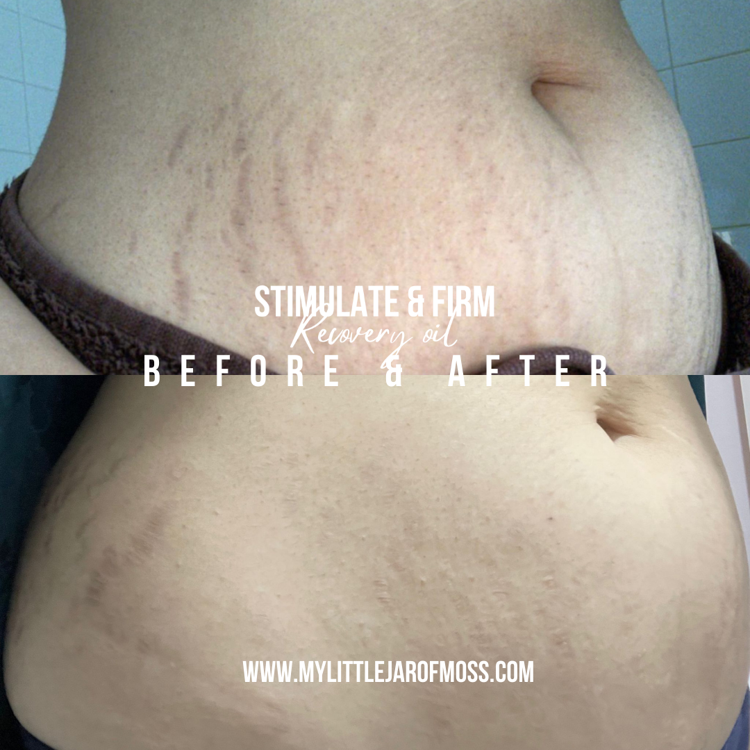 PRE ORDER Stimulate and firm stretch mark kit